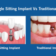 Single stage vs Traditional Implant