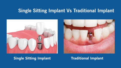 Single stage vs Traditional Implant