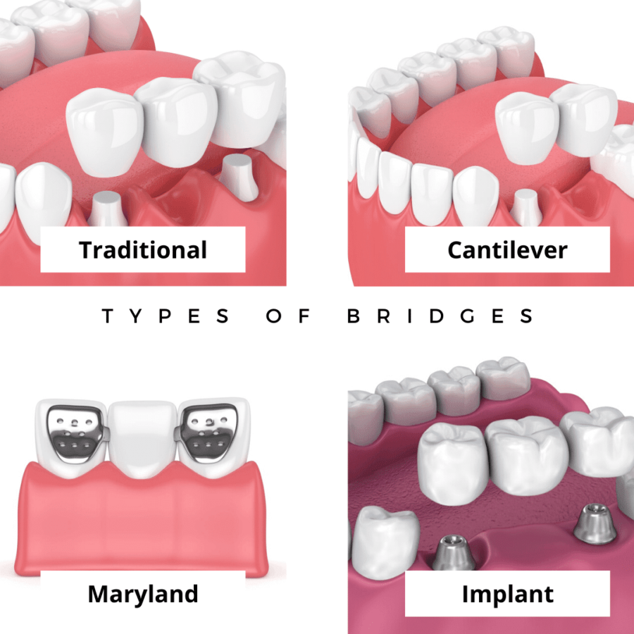 dental bridges type