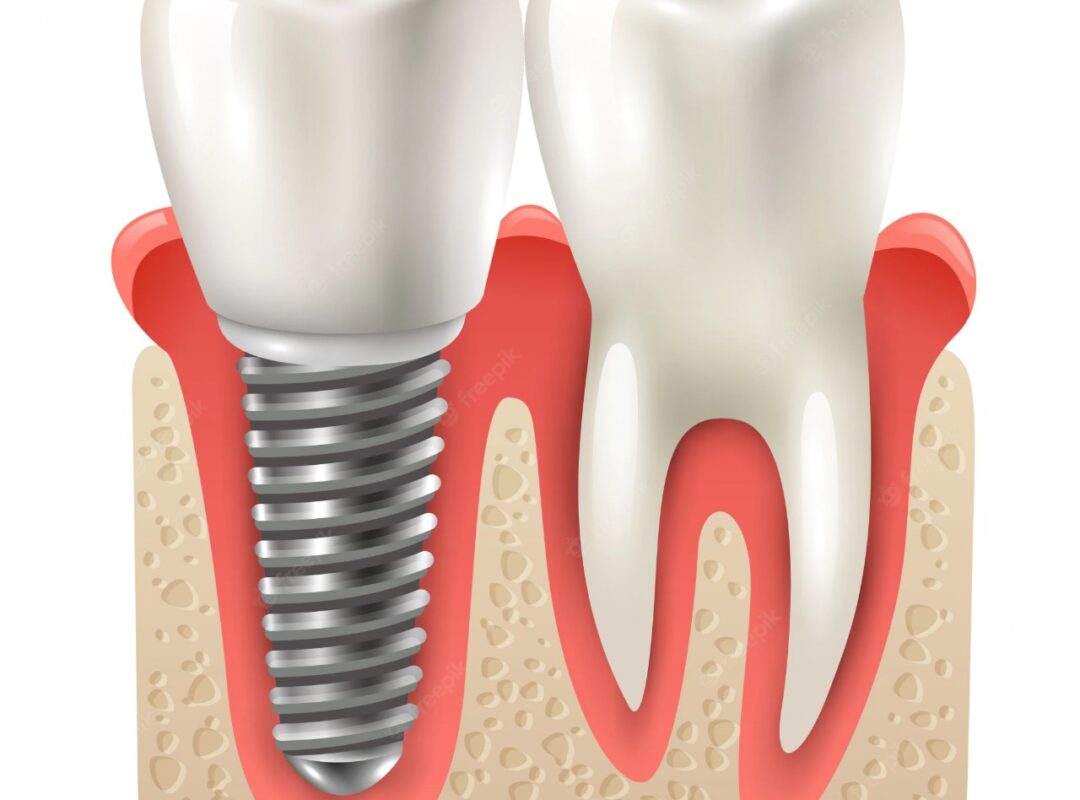 dental implant and tooth