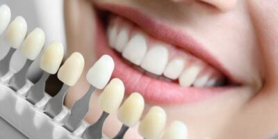 DENTAL Veneers