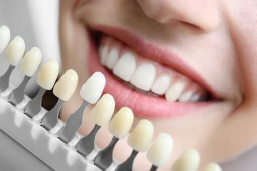 DENTAL Veneers