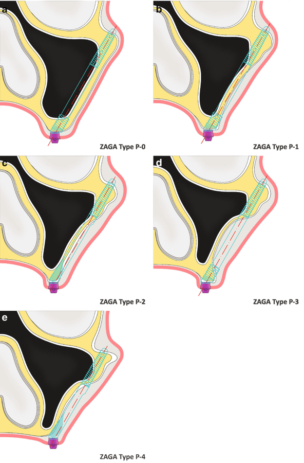 All about Zygomatic Dental Implant: A Complete Guide for Severe Bone Loss Royal Dental Clinics Zaga Classcification