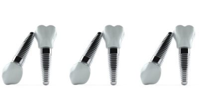 Aluminium dental implants