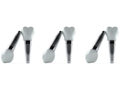 Aluminium dental implants