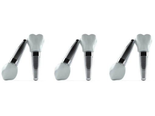 Aluminium dental implants