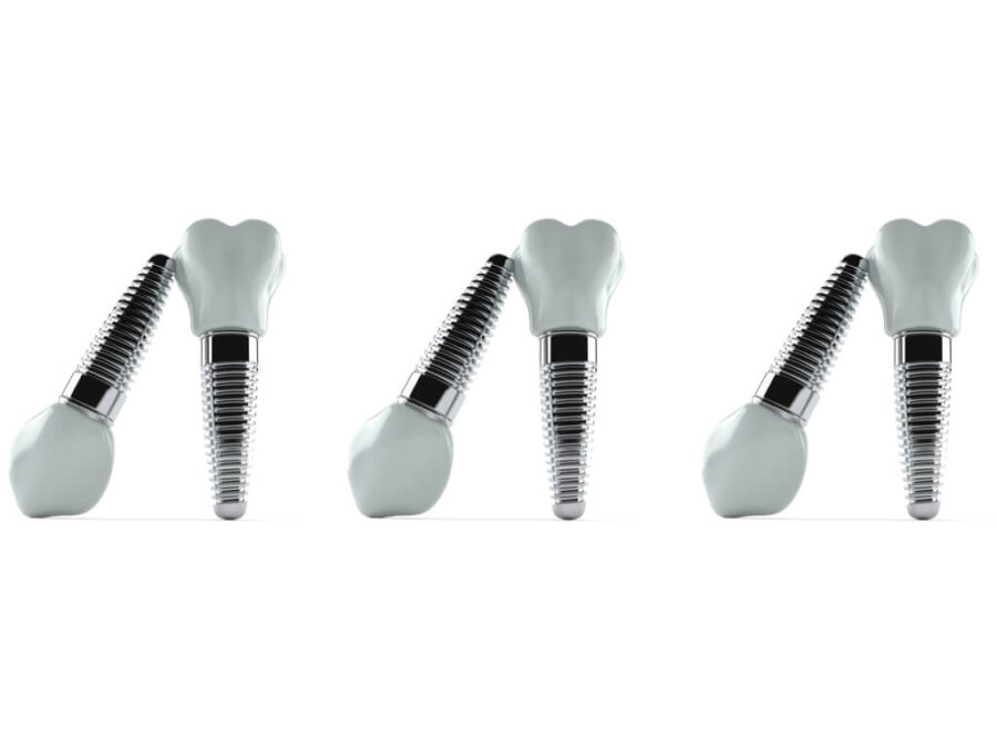 Aluminium dental implants