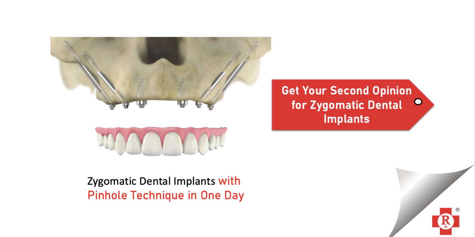 Zygomatic Dental ImplantZygomatic Dental Implant