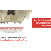 Zygomatic Dental ImplantZygomatic Dental Implant