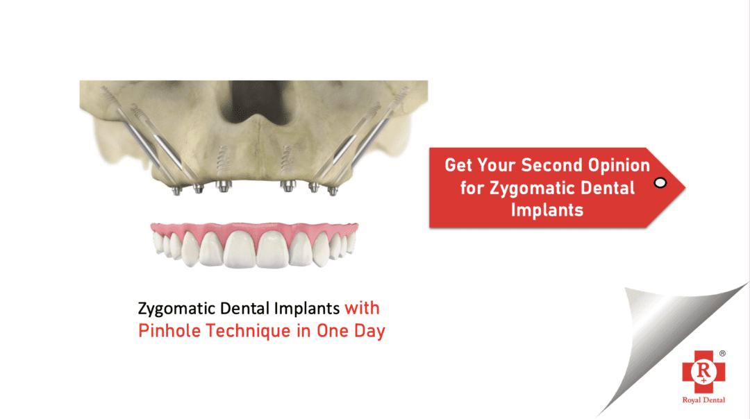 FAQs on Zygomatic Dental Implants Royal Dental Clinics Blog