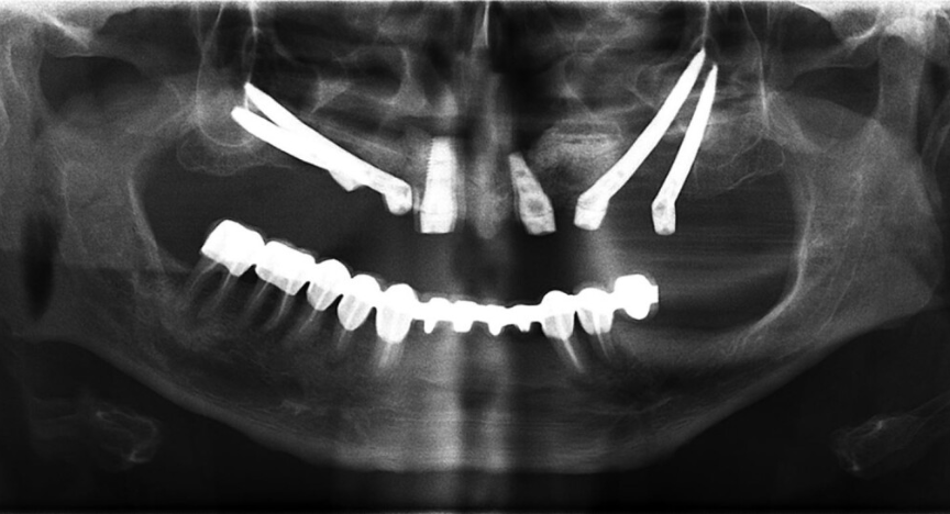 Zygomatic Dental Implants for Atrophic Maxilla