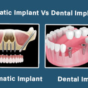 Zygomatic dental Implants in one day
