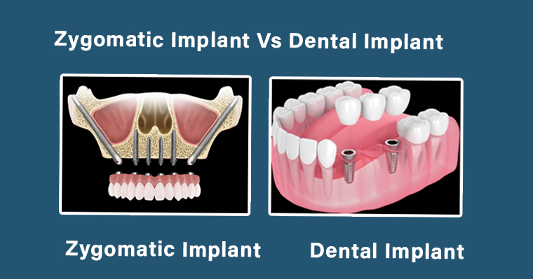 Zygomatic dental Implants in one day