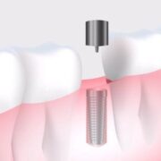 Loose Dental Implants