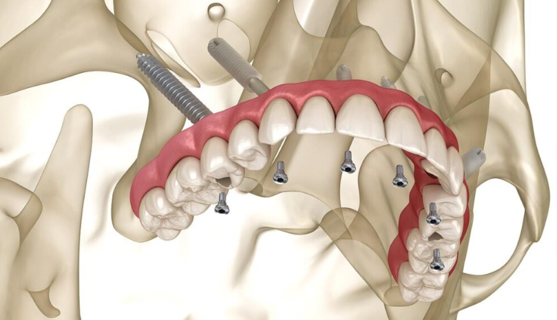 Zygomatic Implants with SAPTeeth Dental Crown