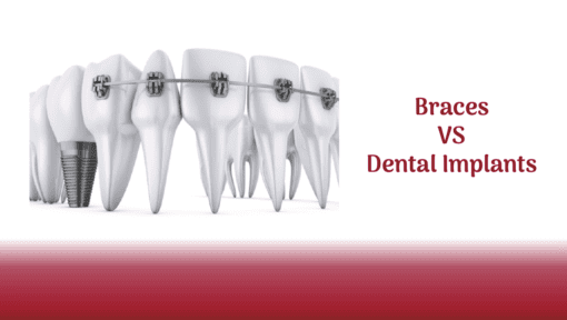 Dental Implants or Braces