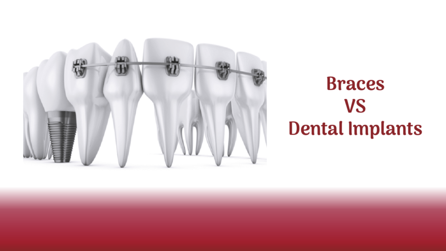 braces vs dental implants