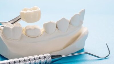 SAPTeeth single crown