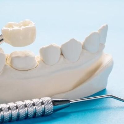 1.How SAPTeeth™ revolutionised Dental Tourism? Royal Dental Clinics SAPTeeth single crown