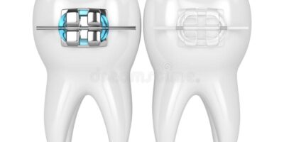 braces vs implant