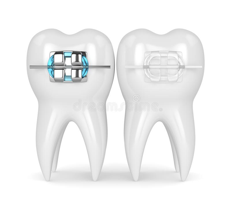 braces vs implant