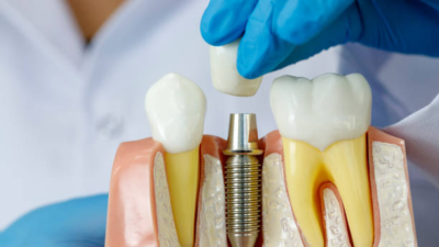 EMI for Dental Implant