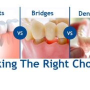 Dental implants Bridges Dentures