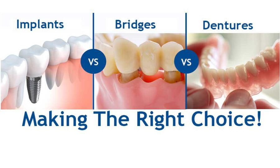 Dental implants Bridges Dentures