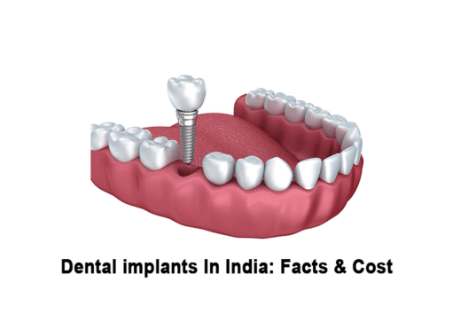 best dental implant in india