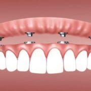 cost of implant denture