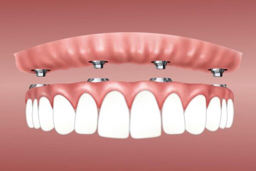 cost of implant denture or All-on-4 Dental Implants