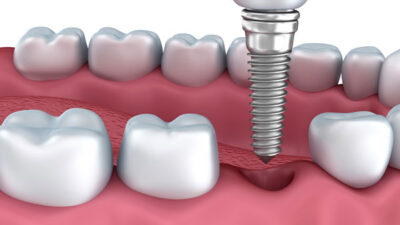 dental implant fall out