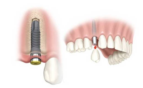 immediate load dental implant pinhole
