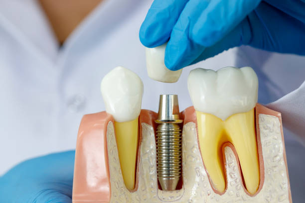 EMI-for-Dental-Implant-AIIMS
