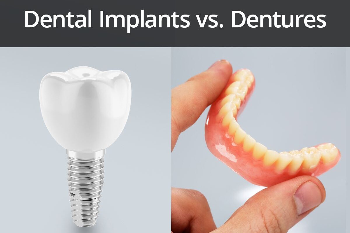 implants vs dentures