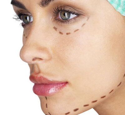 Facial Implants