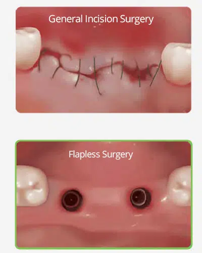 Flapless dental implant
