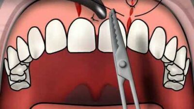 gum suture after implant