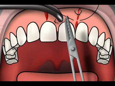 gum suture after implant