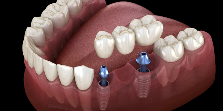 2 stage dental implants