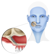 Zygomatic Dental Implant Royal Dental