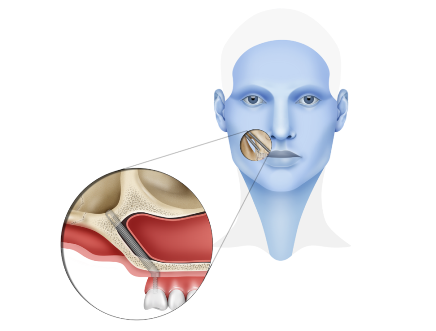 Zygomatic Dental Implant Royal Dental