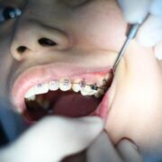 Braces and wires orthodontics