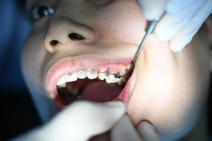 Braces and wires orthodontics