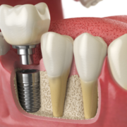 Dental Implant with Crown