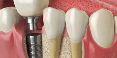 Dental Implant with Crown