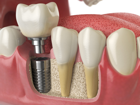 Dental-Implant-with-Crown