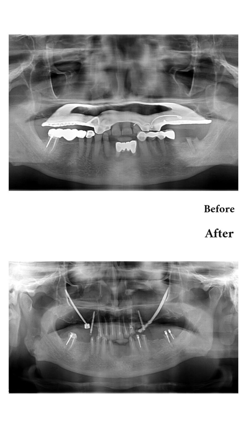 Before After Zygomatic Implant