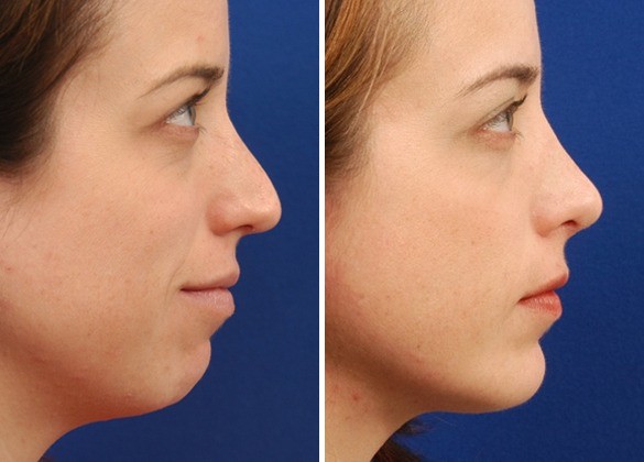 Chin Facial Implants