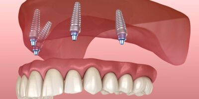 full mouth dental implants